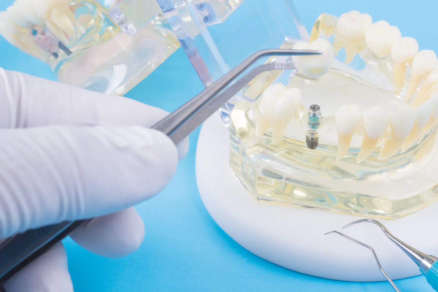 Klinika implantologiczna Warszawa