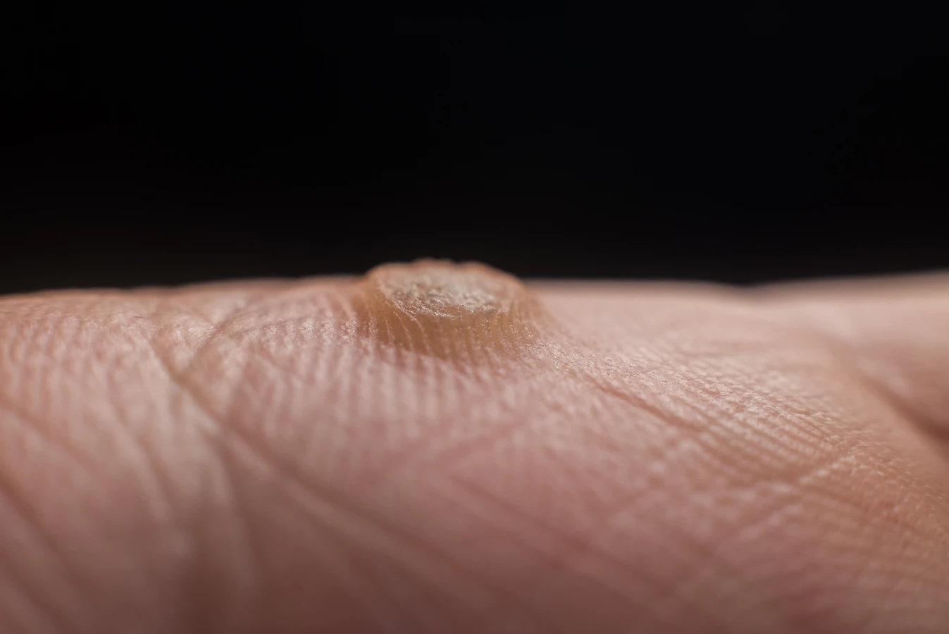 Ile kosztuje usunięcie kurzajki u dermatologa?