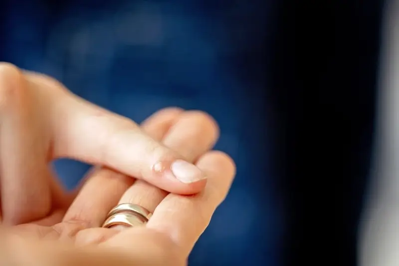 Ile kosztuje usunięcie kurzajki?